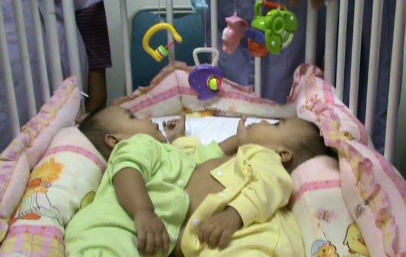 Bayi kembar siam Wanda Wandi kini semakin sehat dan akan siap untuk dioperasi setelah usia 1 tahun